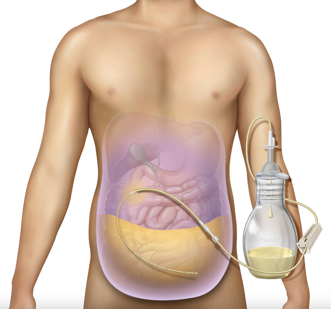PLEURX PERITONEAL CATHETER KIT